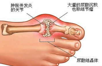 痛風(fēng)最新治療進(jìn)展與策略綜述